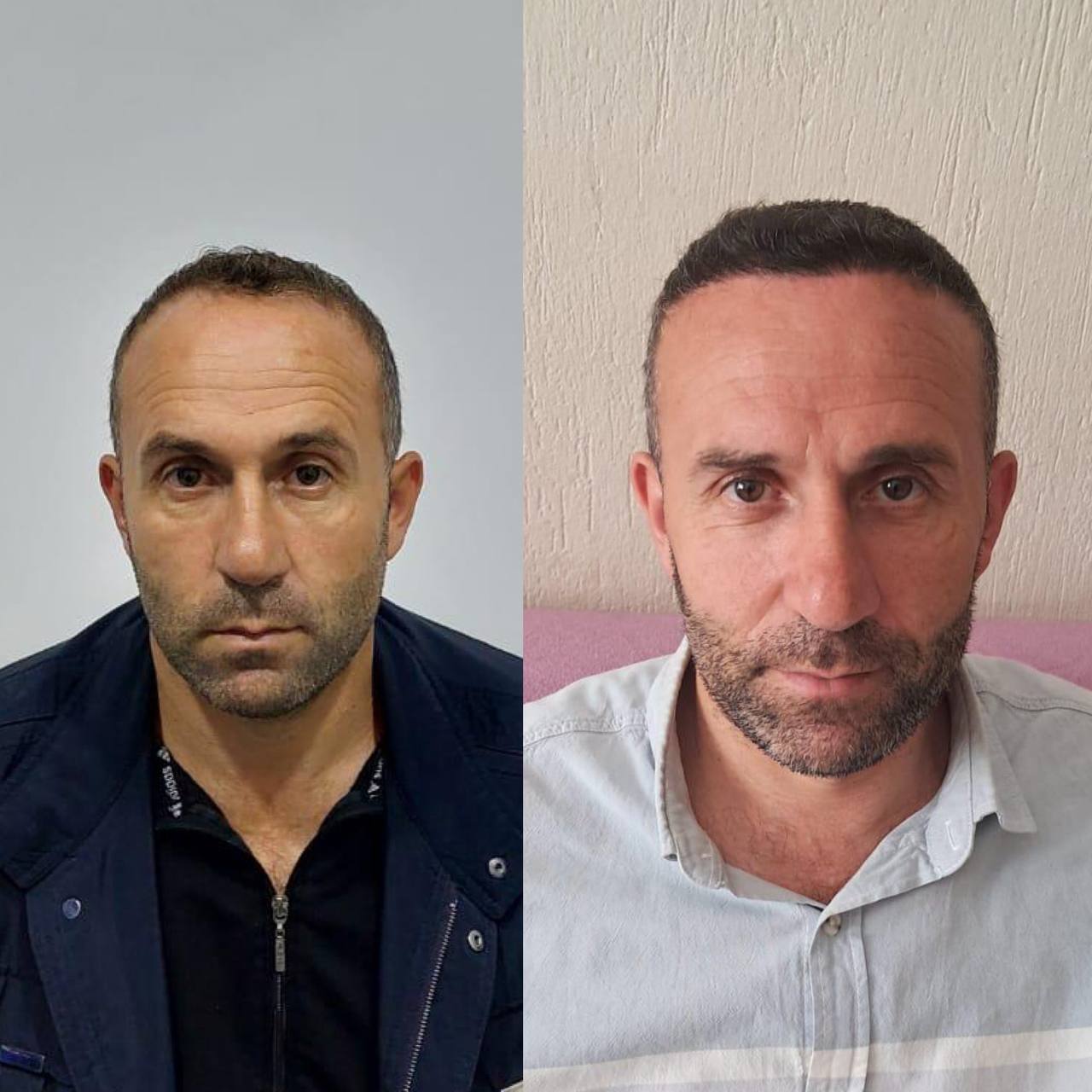 Saç Ekimi Örnek 2