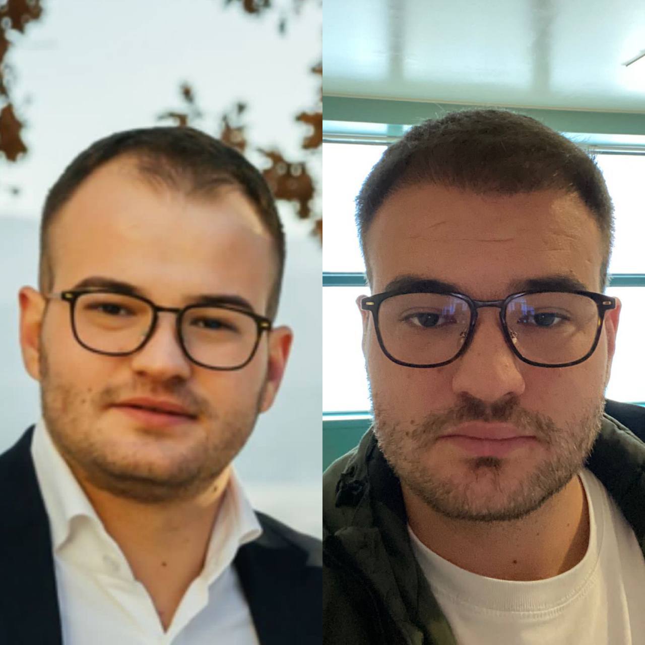 Saç Ekimi Örnek 3