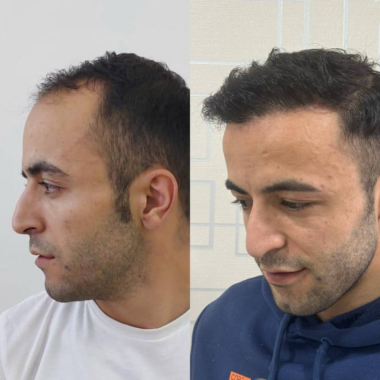 Saç Ekimi Örnek 5
