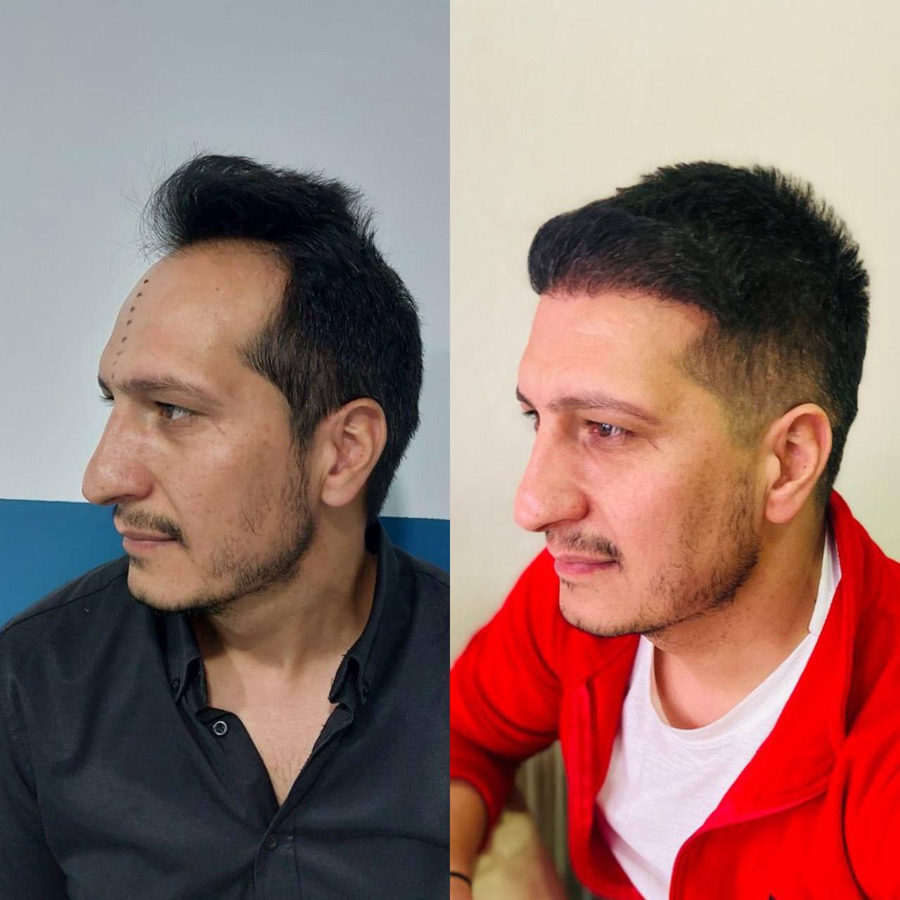 Saç Ekimi Örnek 6